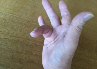 変形した指が少し治ってまいりました。